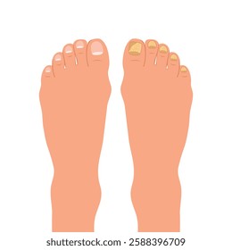 Nail disease. Onychomycosis concept. Fungal nail infection.  Medical illustration in flat design. 