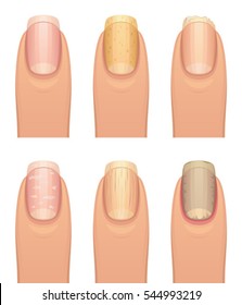 Mycose Ongle Stock Vectors Images Vector Art Shutterstock