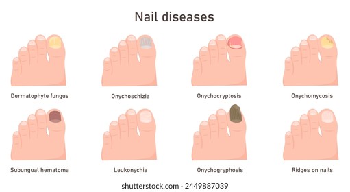 Nail diseases, nail fungal infection. Onychomycosis, onycholysis. Problem toenail Vector illustration of nails