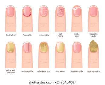 Nail Diseases. Health painful sickness or injured nails problem, fingernail infections conditions treatment medical dermatology diagnosis illness finger, swanky Vector Illustration authors graphics