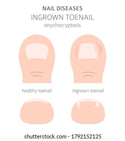 Nail diseases. Onychocryptocosis, ingrown toenail. Medical infographic design.  Vector illustration