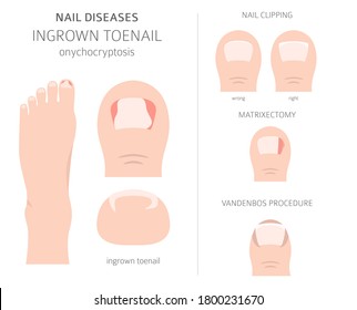 Nail diseases. Onychocryptocosis, ingrown toenail. Medical infographic design.  Vector illustration