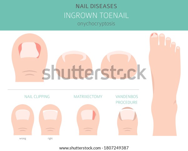 Nail Diseases Onychocryptocosis Ingrown Toenail Medical Stock Vector ...