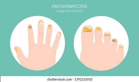 Nail diseases. Onychomycosis, nail fungal infection causes, treatment icon set. Medical infographic design.  Vector illustration