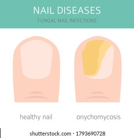 Nail diseases. Onychomycosis, nail fungal infection causes, treatment icon set. Medical infographic design.  Vector illustration