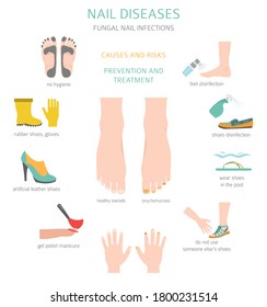 Nail diseases. Onychomycosis, nail fungal infection causes, treatment icon set. Medical infographic design.  Vector illustration