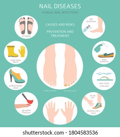 Nail diseases. Onychomycosis, nail fungal infection causes, treatment icon set. Medical infographic design.  Vector illustration