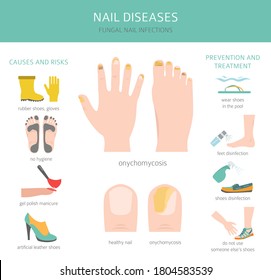 Nail diseases. Onychomycosis, nail fungal infection causes, treatment icon set. Medical infographic design.  Vector illustration