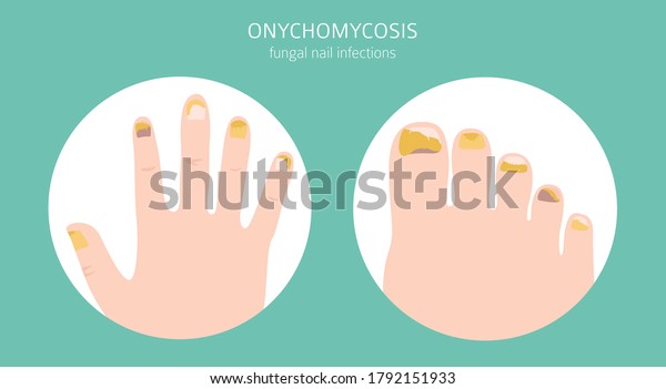 Nail Diseases Onychomycosis Nail Fungal Infection Stock Vector Royalty