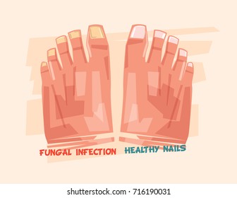 Nail fungus