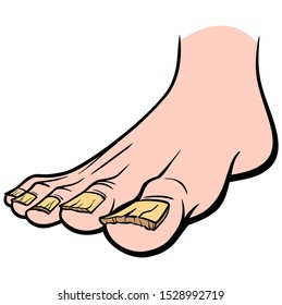 Nail Fungus - A cartoon illustration of a foot with Nail Fungus.