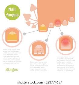 Nail fungus infection. Vector Cartoon.  Flat. Medical illustration for magazines, websites, brochures. 