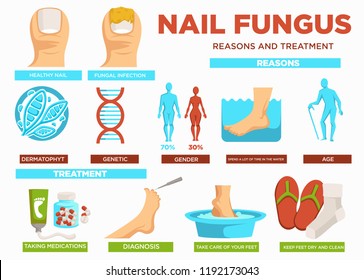 Nail fungus reasons and treatment poster with text vector