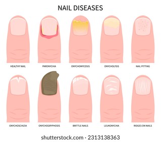 nail pain or onycholysis yellow peeling toes health and Beau's line syndrome white bands ridge damage of split care Tinea liver zinc iron crumbly fissure bed matrix spots big spoon kidney cancer