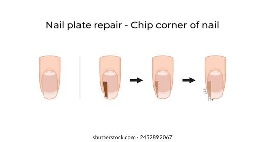 Nail plate repair - Chip corner of nail