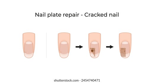 Nail plate repair - Cracked nail