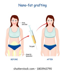 Nano-Fat Grafting use to fix problems with skin (wrinkles, scars, acne). vector diagram. Fat graft before and after. Illustration about Cosmetic surgery.