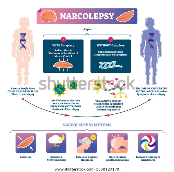 Narcolepsy vector illustration. Labeled muscle\
strength disease infographic. Medical sleep loss explanation scheme\
with cataplexy types. Anatomical symptom list and immune system\
brain attack\
diagram.