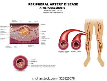 Narrowed Leg Artery By The Atherosclerosis, Plaque In The Inner Surface. 