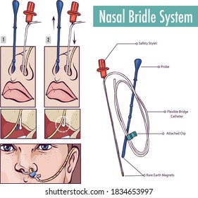 A nasal bridle attaching a nasogastric tube to the nasal septum to prevent accidental pullout svg