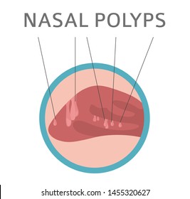 Nasal diseases. Nasal polyps causes, diagnosis and treatment medical infographic design. Vector illustration