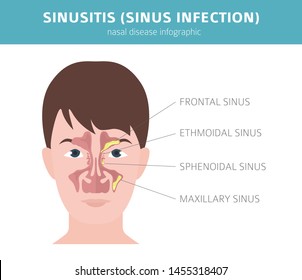 Vektor Stok Nasal Diseases Sinusitis Sinus Infection Diagnosis (Tanpa ...