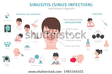 Nasal diseases. Sinusitis, sinus infection diagnosis and treatment medical infographic design. Vector illustration