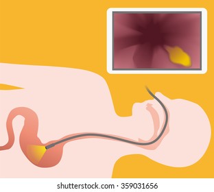 nasal endoscope, gastroscopy, vector illustration