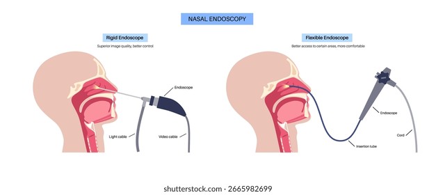 Nasal endoscopy, minimally invasive diagnostic procedure, flexible or rigid endoscope to examine the nasal cavity, sinuses, and nasopharynx. Chronic sinusitis, nasal polyps, deviated septum or tumor