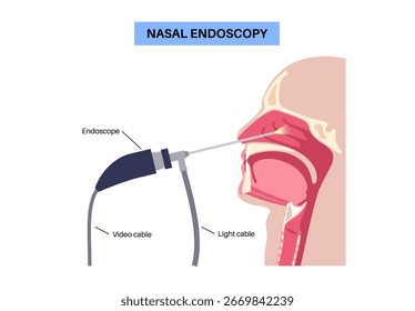 Nasal endoscopy, minimally invasive diagnostic procedure. Rigid endoscope. Exam of the nasal cavity, sinuses, and nasopharynx. Chronic sinusitis, nasal polyps, deviated septum or tumor flat vector