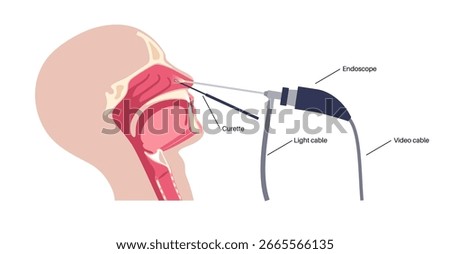 Nasal endoscopy, minimally invasive diagnostic procedure. Rigid endoscope. Exam of the nasal cavity, sinuses, and nasopharynx. Chronic sinusitis, nasal polyps, deviated septum or tumor flat vector