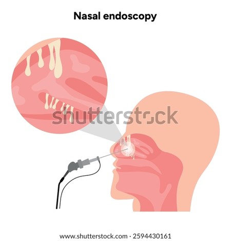 Nasal endoscopy procedure nasal and sinus passages. Thin, flexible tube with camera and light. Medical diagram