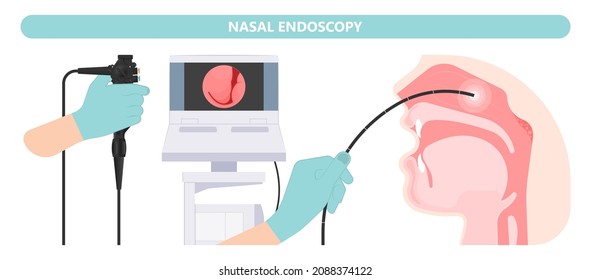 Nasal Endoscopy. Throat back voice box larynx vocal cord pain airway endoscopic sinus surgery ear nose sleep apnea oral airway septal obstructive biopsy tumor Pharynx flexible fibre optic polypectomy