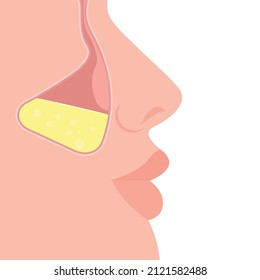 Síntomas maxilares nasales en perfil. Parte de la cara con nariz y labios. Ilustración vectorial, diseño de color de caricatura plana, aislado en fondo blanco, eps 10.