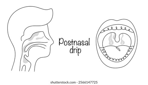 The nasal mucosa secretes excessive amounts of mucus, which drains down the back of the throat. Hand drawn medical vector illustration. Postnasal drip. 