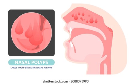 Nasal Polypectomy Throat Back Voice Box Larynx Vocal Cord Pain Airway Endoscopic Sinus Surgery Ear Nose Sleep Apnea Oral Airway Septal Obstructive Biopsy Tumor Pharynx Flexible Fibre Optic