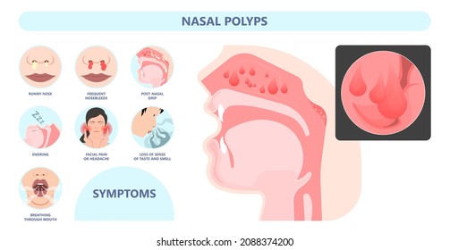 Nasal Polypectomy Throat Back Voice Box Larynx Vocal Cord Pain Airway Endoscopic Sinus Surgery Ear Nose Sleep Apnea Oral Airway Septal Obstructive Biopsy Tumor Pharynx Flexible Fibre Optic