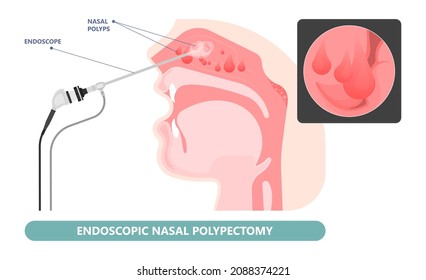 Nasal Polypectomy Throat Back Voice Box Larynx Vocal Cord Pain Airway Endoscopic Sinus Surgery Ear Nose Sleep Apnea Oral Airway Septal Obstructive Biopsy Tumor Pharynx Flexible Fibre Optic