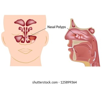 Nasal polyps