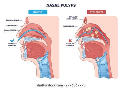 Nasal polyps brief overview showing healthy vs polyp-filled sinuses, with airflow arrows illustrating obstruction, key elements, nasal cavity, polyps, inflamed lining. Diagram