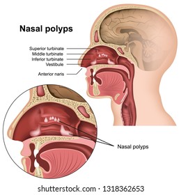 Nasal polyps medical vector illustration on white background