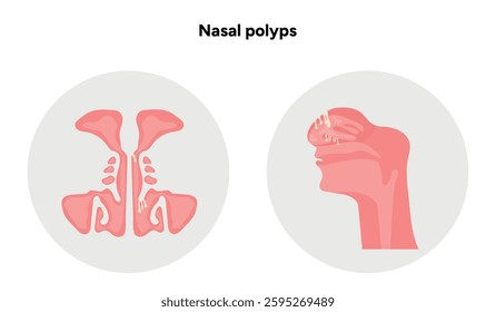 Nasal polyps, nose disease. Diagnostic and treatment. Medical diagram anatomy