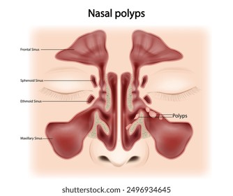 Nasal polyps (NP) Noncancerous growths on the lining of the nose or sinuses. Otorhinolaryngology