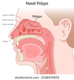 nasal polyps in the sinus cavity, labeled with turbinates and nasal anatomy for educational purposes diagram hand drawn schematic vector illustration. Medical science educational illustration