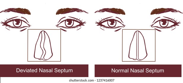 Nasal Septum Deviation Treatmen