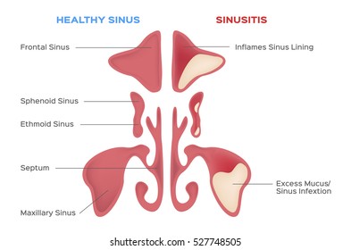 nasal sinus. Healthy and inflammation vector
