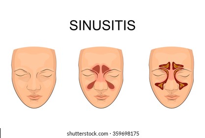 seio nasal. inflamação