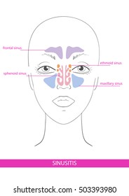 nasal sinus. inflammation