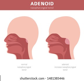 Nasal and throat, nasopharynx diseases. Adenoids diagnosis and treatment medical infographic design. Vector illustration