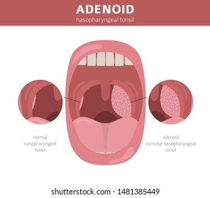 Nasal and throat, nasopharynx diseases. Adenoids diagnosis and treatment medical infographic design. Vector illustration